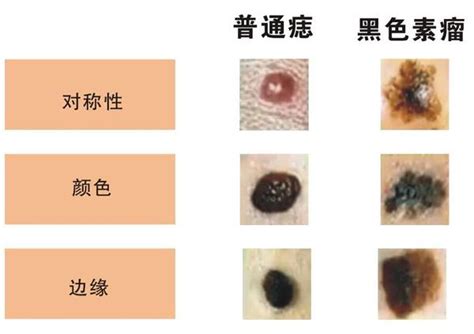 臉部 痣|是痣還是瘤？黑色素瘤的類型、症狀與治療